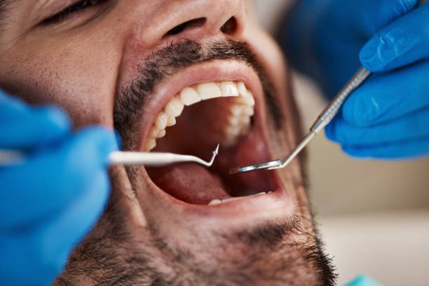 Best Emergency Dentist for Knocked-Out Tooth in Lake Secession, SC