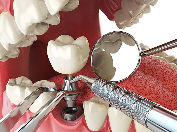 Best Emergency Dental Care for Abscessed Tooth in Lake Secession, SC